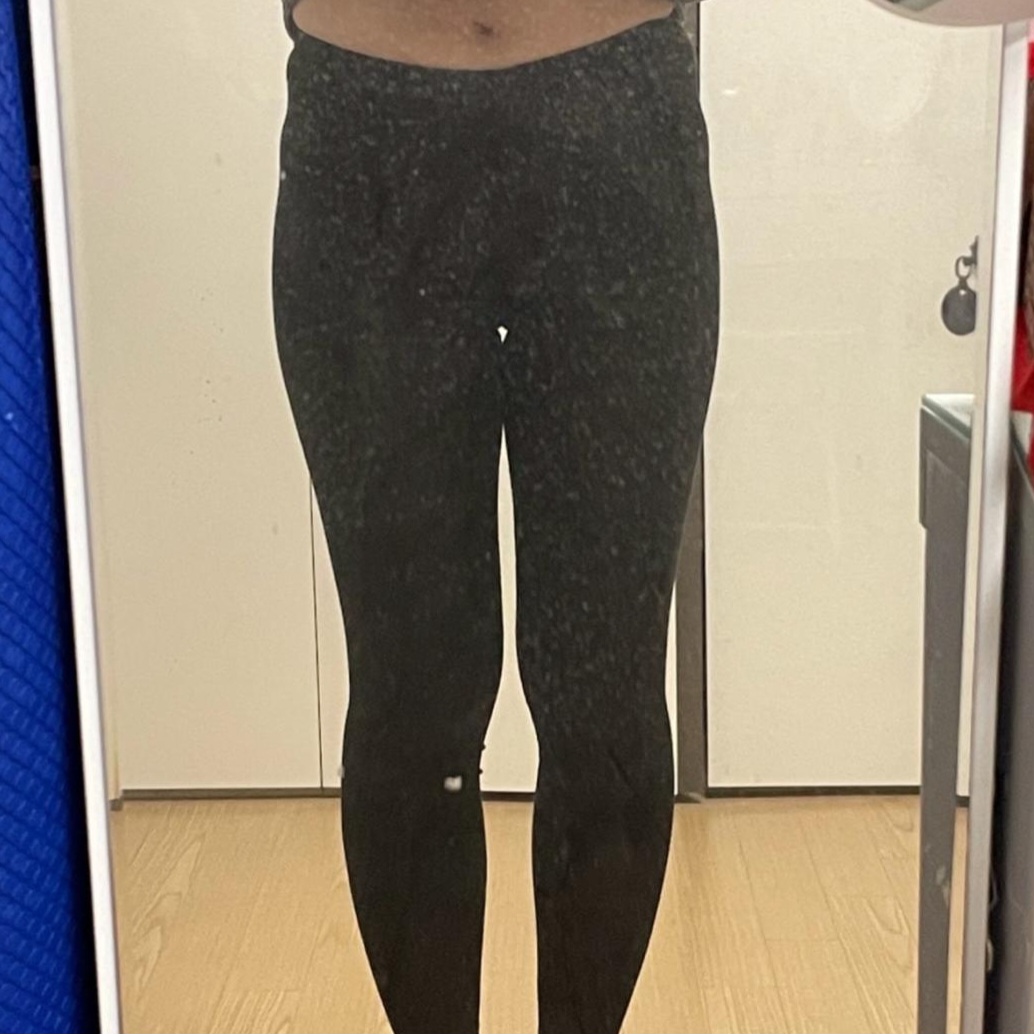 thigh-liposuction-before_Sappo
