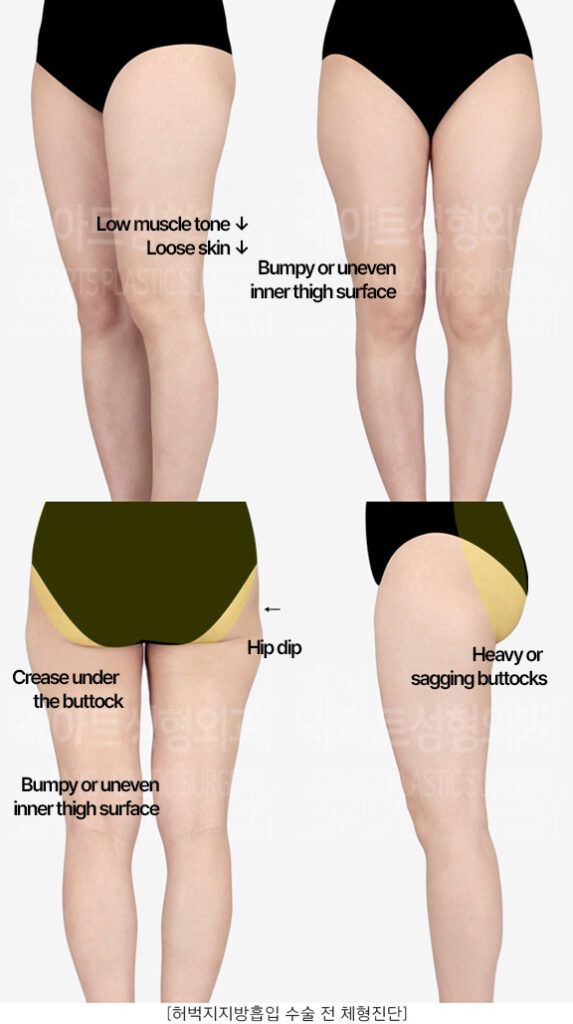 thigh-liposuction-hip-line_02_01_230416