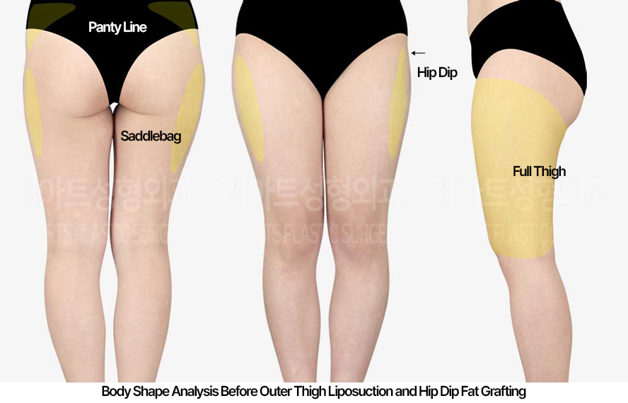 thigh-liposuction-hip-line_02_01_230422