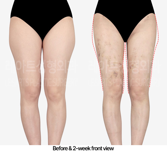 thigh-liposuction-hip-line_02_02_230416