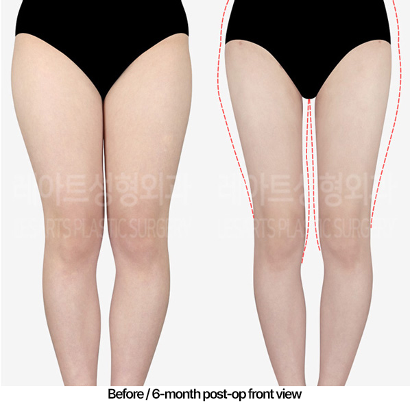 thigh-liposuction-hip-line_02_02_230422