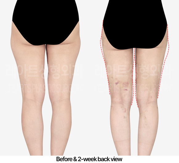thigh-liposuction-hip-line_02_03_230416