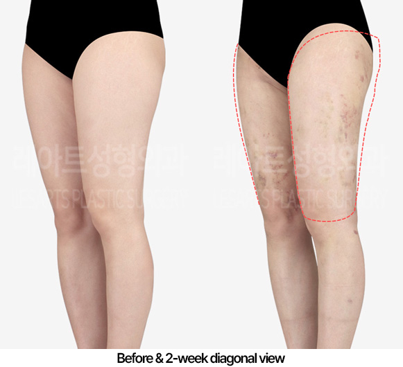 thigh-liposuction-hip-line_02_04_230416