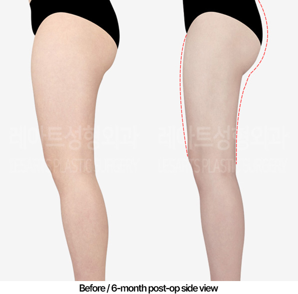 thigh-liposuction-hip-line_02_04_230422