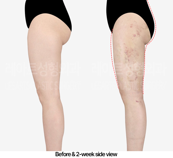 thigh-liposuction-hip-line_02_05_230416