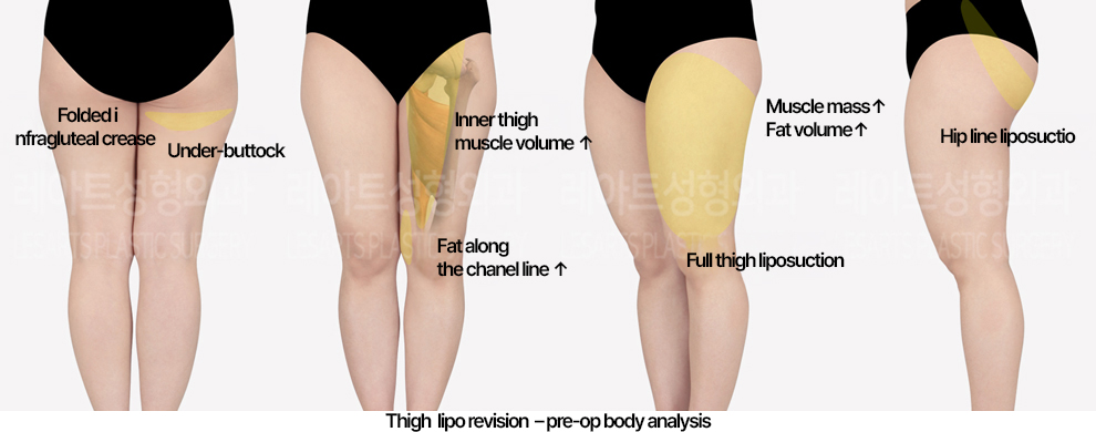 thigh-liposuction-revision-02_01_240502
