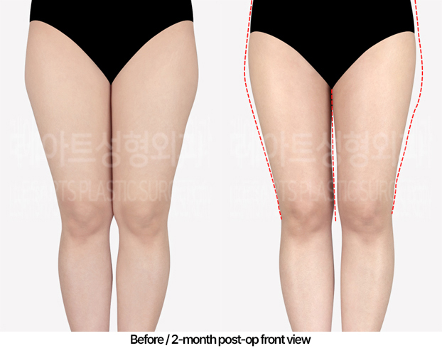 thigh-liposuction-revision-02_02_240502