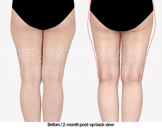 thigh-liposuction-revision-02_03_240502