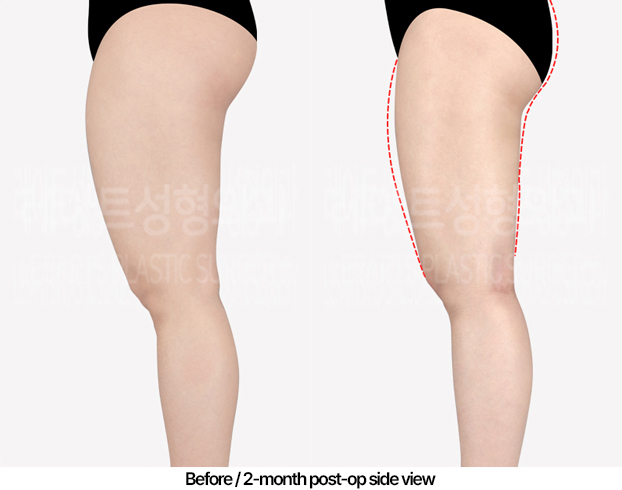 thigh-liposuction-revision-02_04_240502