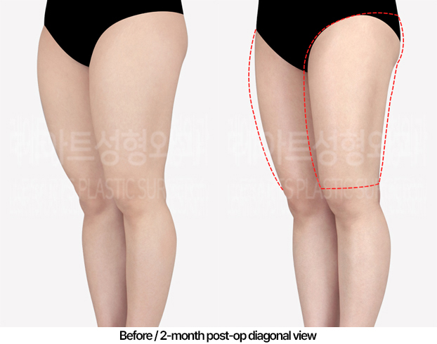 thigh-liposuction-revision-02_05_240502