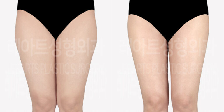 thigh-liposuction-revision-thumbnail_240502