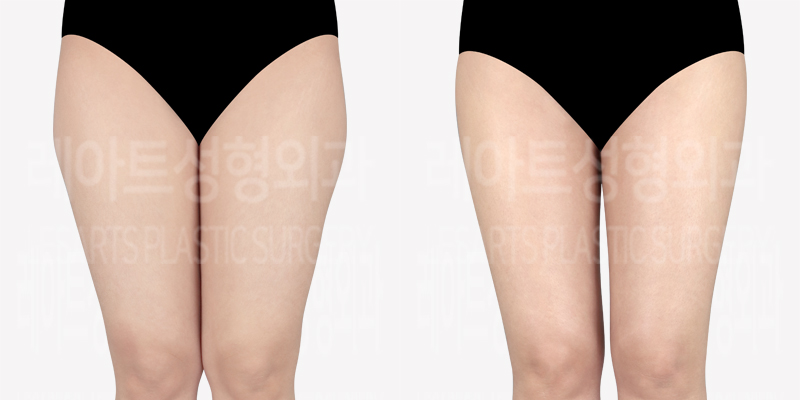 thigh-liposuction-revision-thumbnail_240502