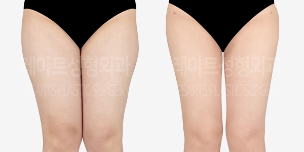 thigh-liposuction-thigh-Fat-Transfer-01-Thumbnail-240403