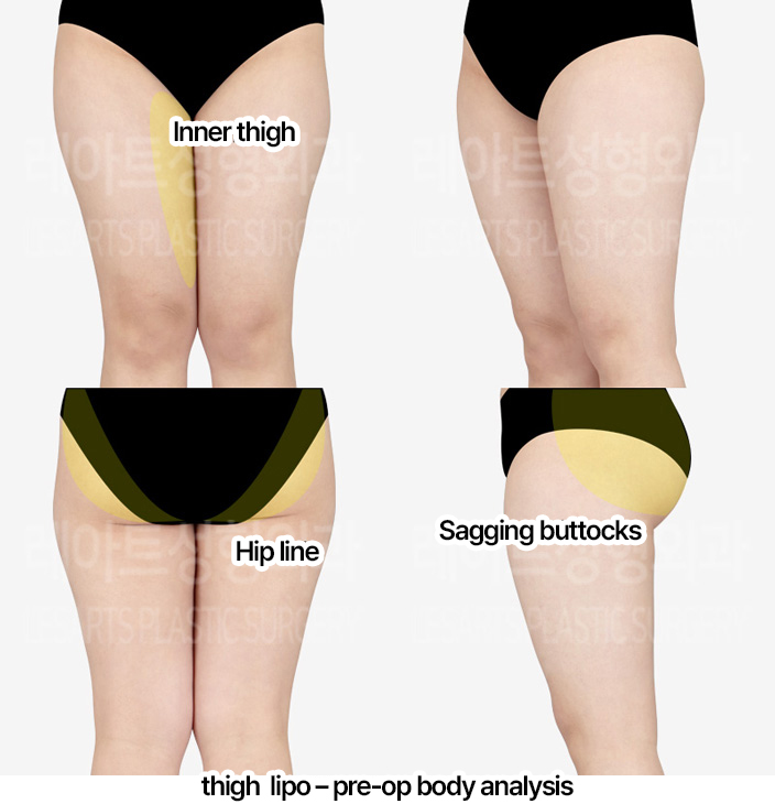thigh-liposuction-thigh-Fat-Transfer-02-01-240403
