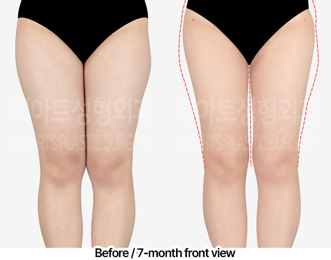 thigh-liposuction-thigh-Fat-Transfer-02-02-240403