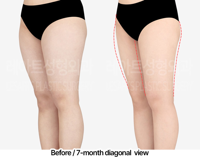 thigh-liposuction-thigh-Fat-Transfer-02-03-240403