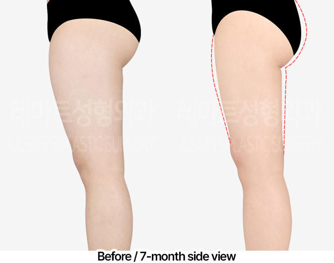 thigh-liposuction-thigh-Fat-Transfer-02-04-240403