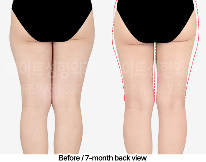thigh-liposuction-thigh-Fat-Transfer-02-05-240403