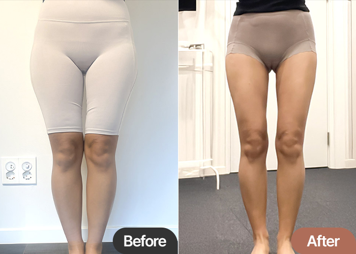thigh-liposuction-thumbnail-avocadojoa