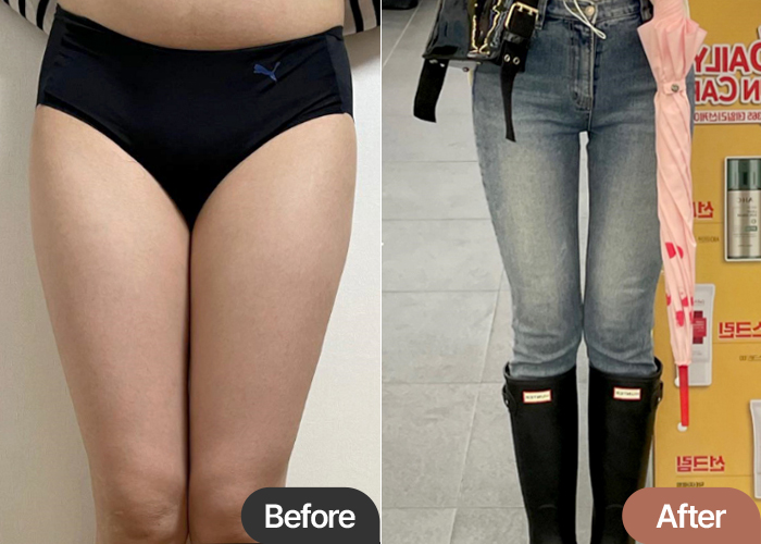 thigh-liposuction-thumbnail-selfie-Achimhasal