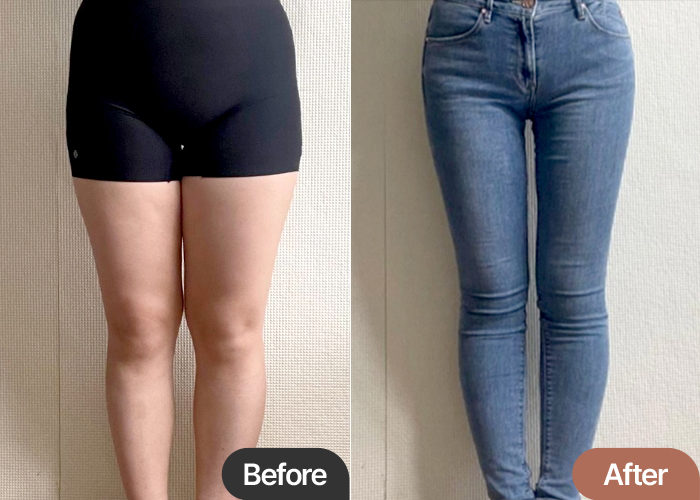 thigh-liposuction-thumbnail-selfie-Akgeoinhyeong