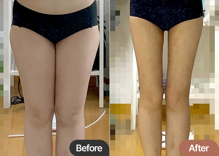 thigh-liposuction-thumbnail-selfie-Angpettichel