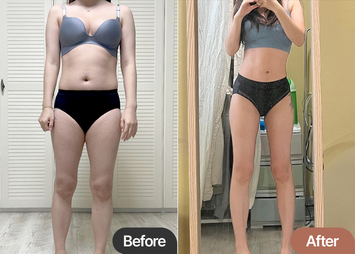 thigh-liposuction-thumbnail-selfie-Bo02
