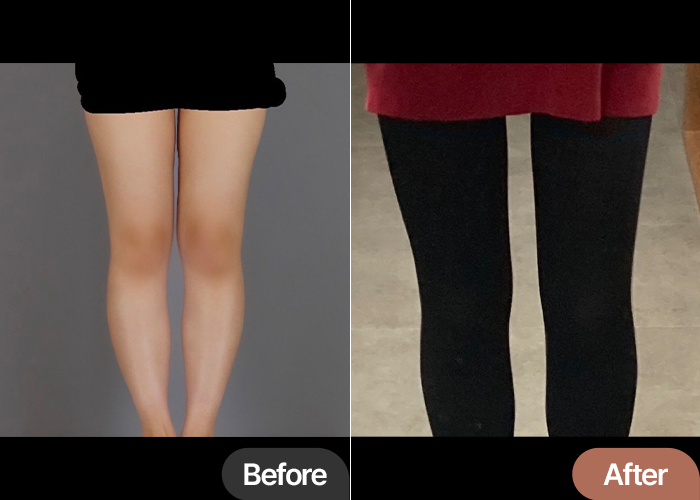 thigh-liposuction-thumbnail-selfie-Chokchokhan
