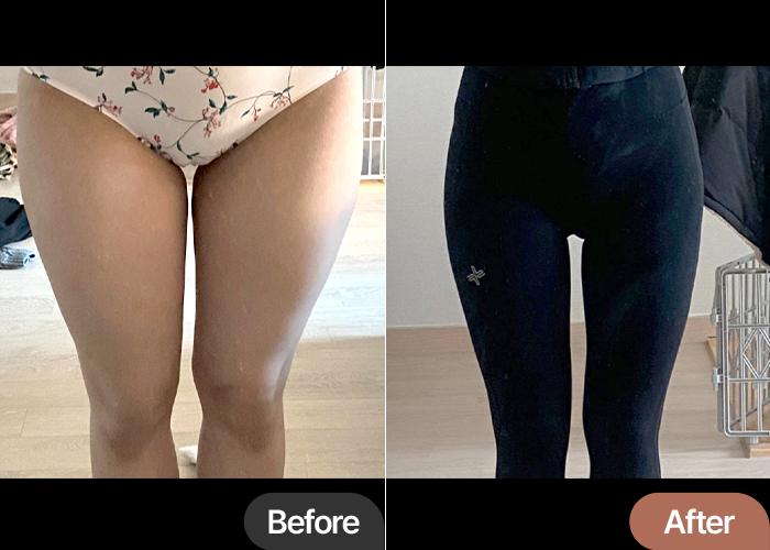 thigh-liposuction-hip-fat-grafting-thumbnail-selfie-Dahonii
