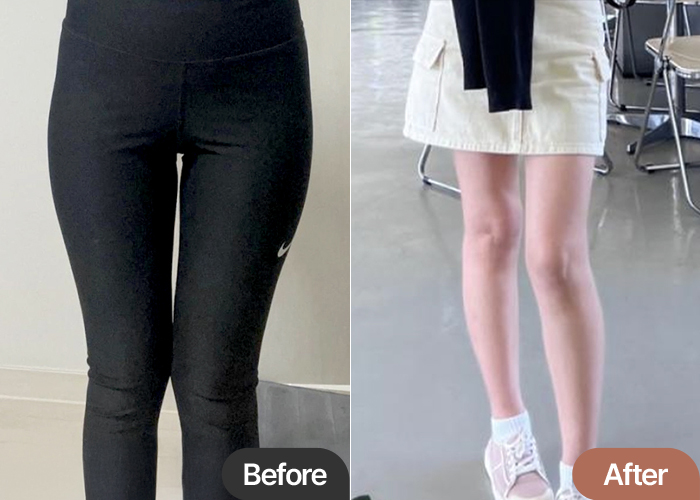 thigh-liposuction-thumbnail-selfie-Goseumdok
