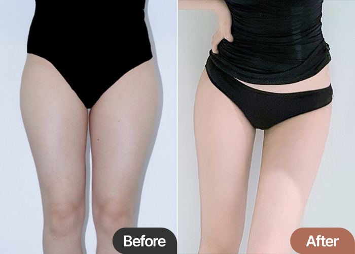 thigh-liposuction-thumbnail-selfie-Haiyohhu