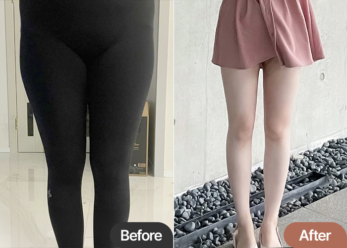 thigh-liposuction-thumbnail-selfie-Mangseon