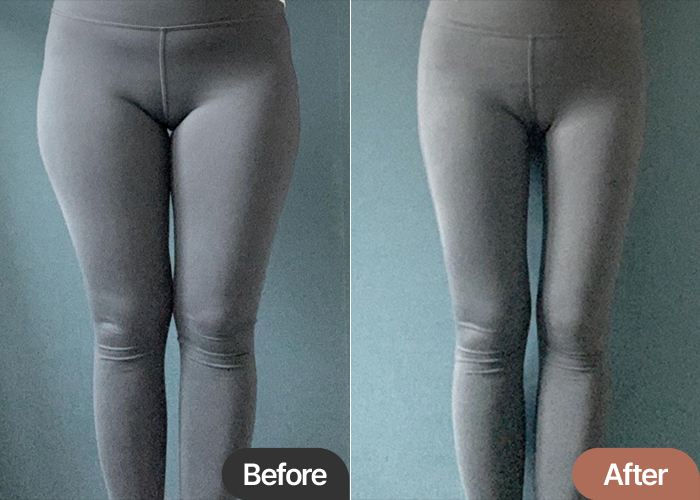 thigh-liposuction-thumbnail-selfie-Papiryu