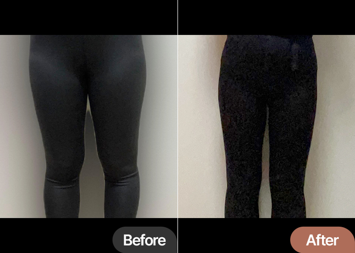 thigh-liposuction-thumbnail-selfie-akfogeiv