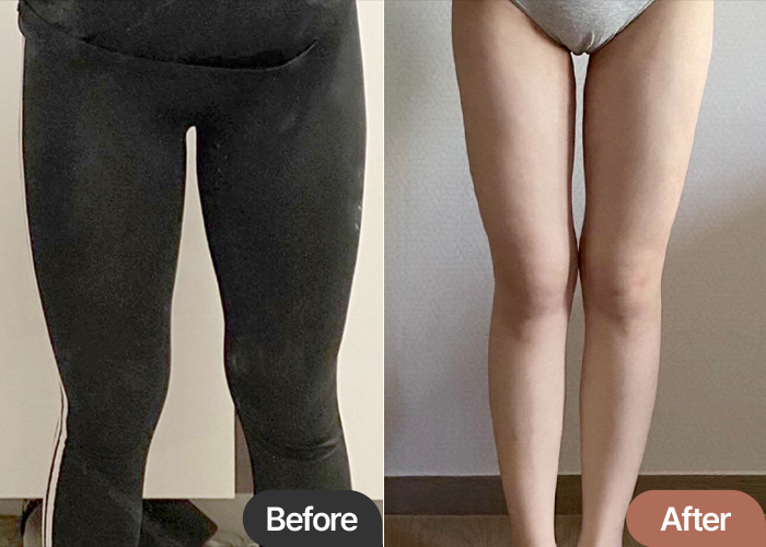 thigh-liposuction-thumbnail-selfie-dbddlll