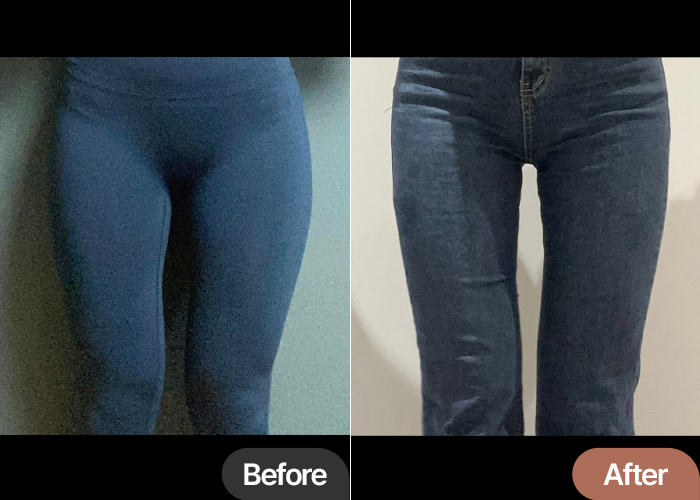 thigh-liposuction-thumbnail-selfie-lalalal9