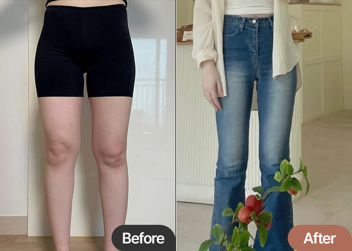 thigh-liposuction-thumbnail-selfie-riniya