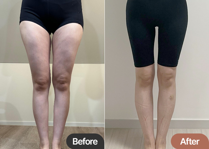 thigh-liposuction-thumbnail-selfie-vvyyu