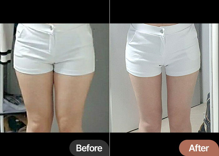 thigh-liposuction-thumbnail-selfie-yndo