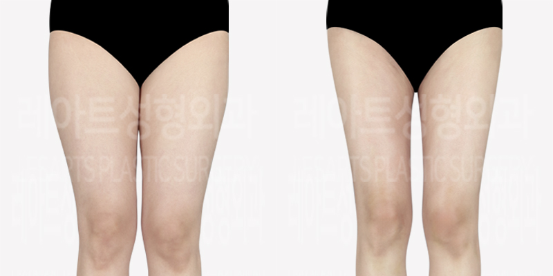 thigh-liposuction-thumbnail_240502