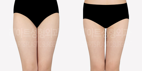 thigh-liposuction-thumbnail_240523