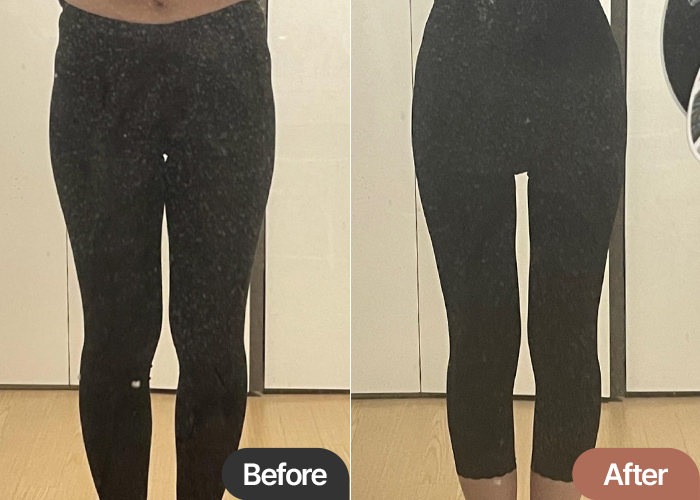 thigh-liposuction-thumbnail_Sappo