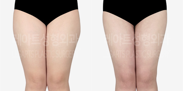 thigh-liposuction_01_thumbnail_230409