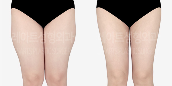 thigh-liposuction_01_thumbnail_230416