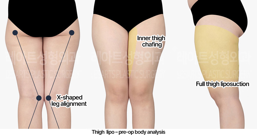 thigh-liposuction_02_01_230409