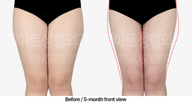 thigh-liposuction_02_02_230409