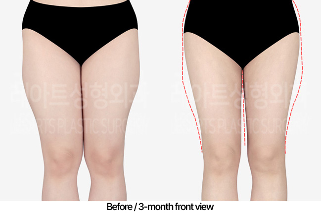 thigh-liposuction_02_02_230416