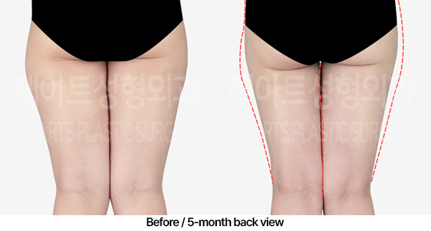 thigh-liposuction_02_03_230409