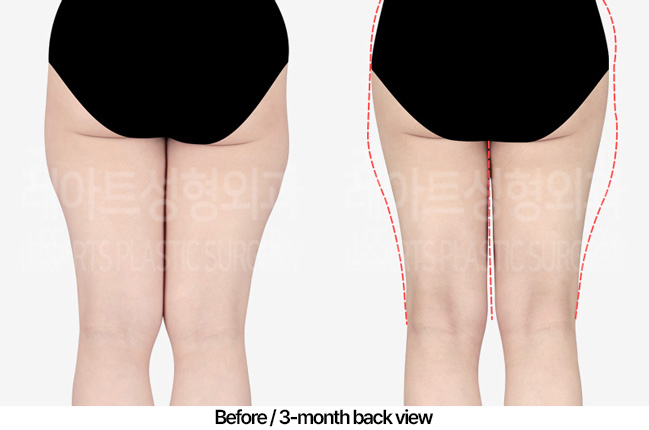 thigh-liposuction_02_03_230416