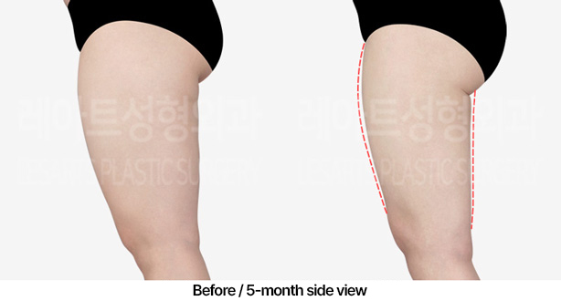 thigh-liposuction_02_04_230409